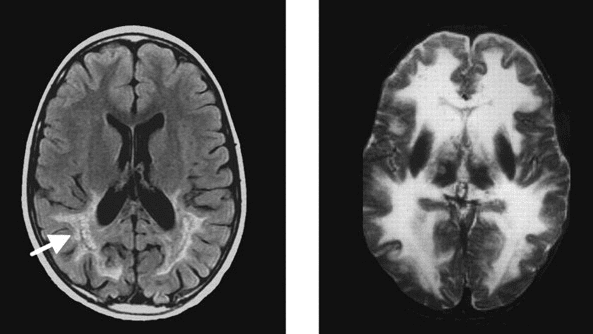 Clinical benefit of lentiviral gene therapy in two patients with a rare ...